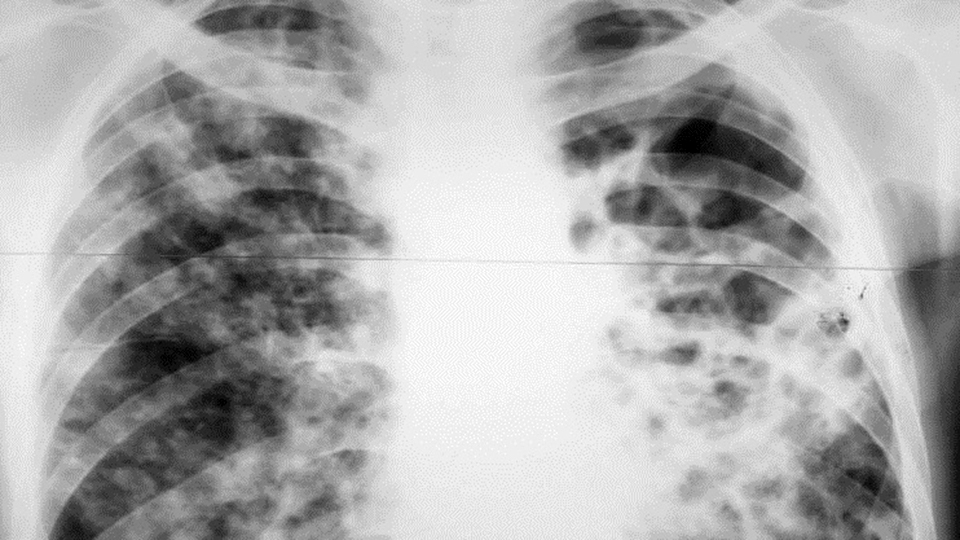 В Энгельсе девушку с туберкулезом принудительно госпитализировали на год